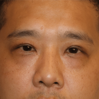 After Image of Eyelid Rejuvenation Las Vegas NV