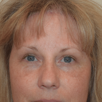 After Image of Brow Lift Las Vegas NV