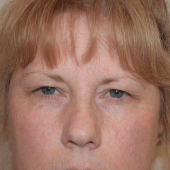 Before Image of Brow Lift Henderson NV