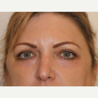 After Image of Laser Resurfacing Henderson NV