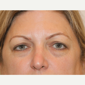 Before image of Laser Resurfacing Henderson NV