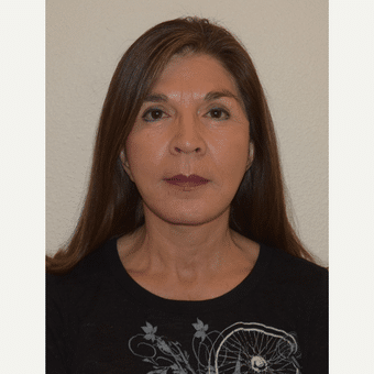 After Image of Facial Implants Las Vegas NV