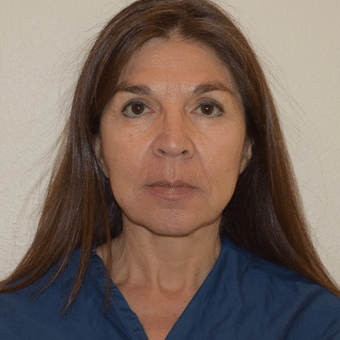 Before Image of Facial Implants Henderson NV
