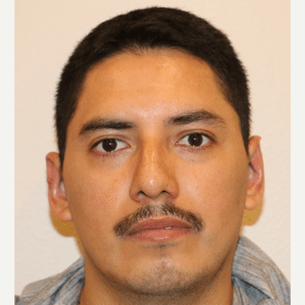 After Image of Otoplasty Las Vegas NV