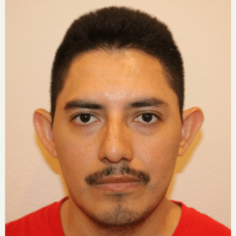 Before Image of Otoplasty Henderson NV