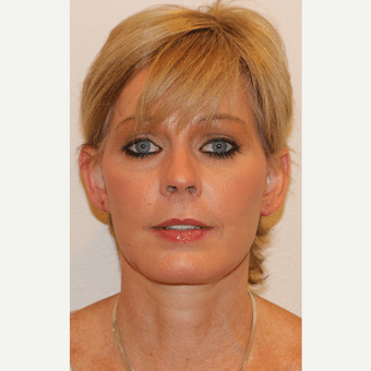 after image of Dermal Fillers Henderson NV