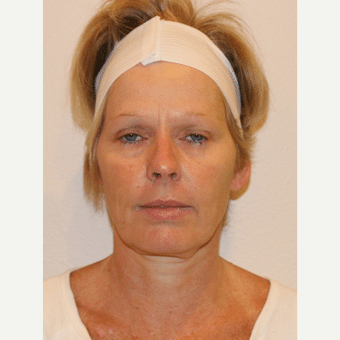 before image of Dermal Fillers Henderson NV