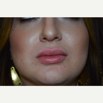 after image of Lip Enhancement Henderson NV