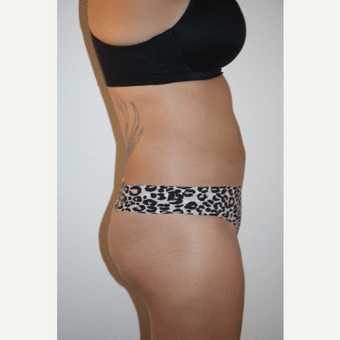 After Image of Liposuction Las Vegas NV