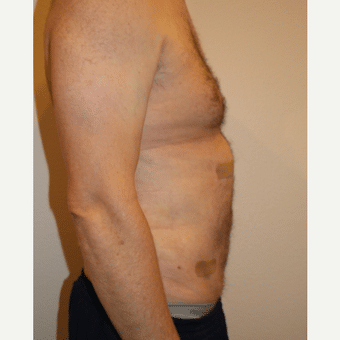 after image of Tumescent Liposuction Henderson NV
