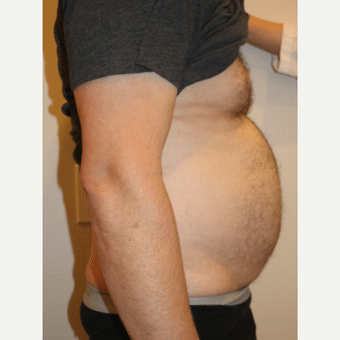 before image of Tumescent Liposuction Henderson NV