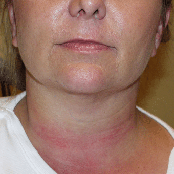 After Image of Neck Lift Las Vegas NV