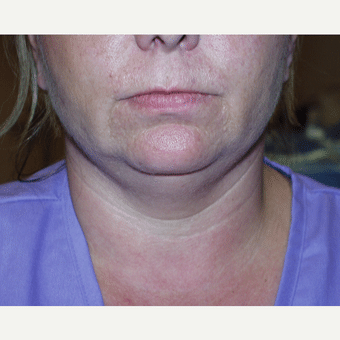 Before Image of Neck Lift Henderson NV