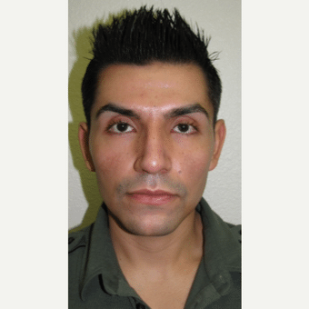 After Image of Rhinoplasty Las Vegas NV