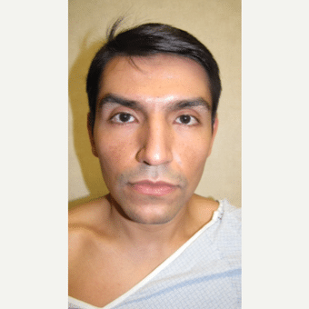 Before Image of Rhinoplasty Henderson NV