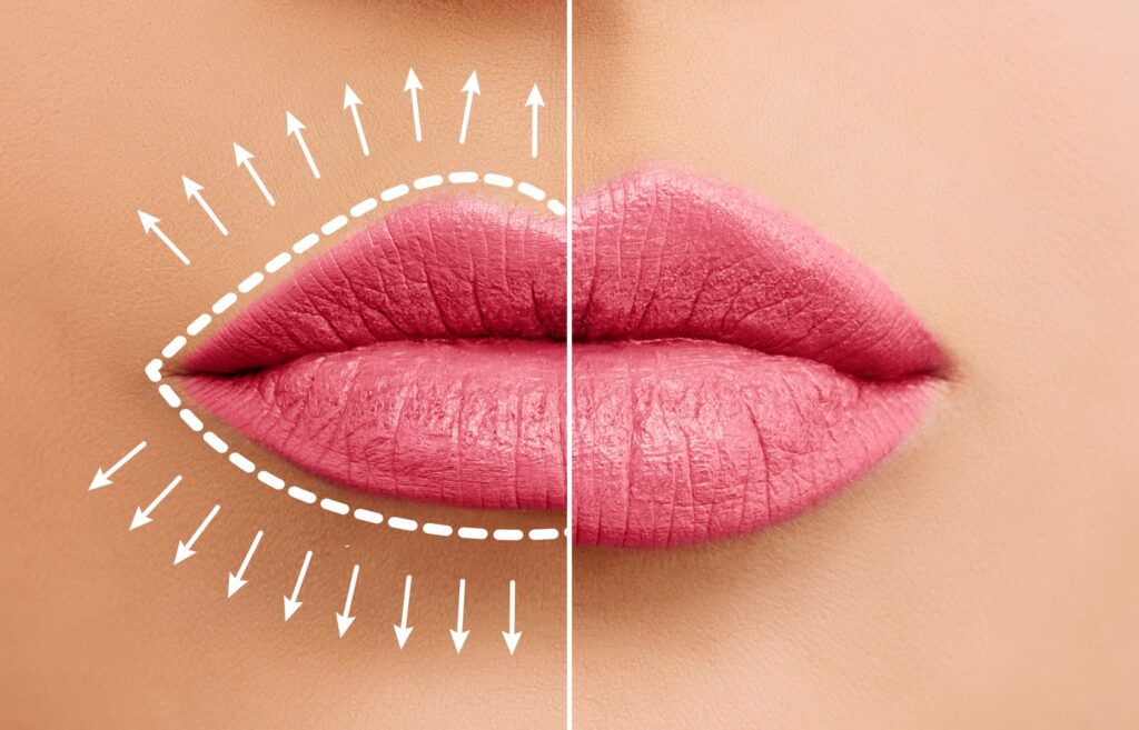 lip plump