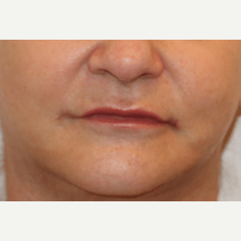 After Image: Lip Implants - front