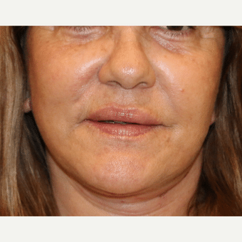 After Image: Lip Implants - front