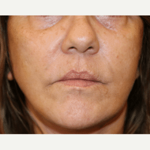 Before Image: Lip Implants