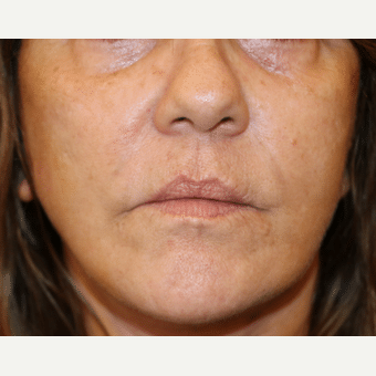 Before Image: Lip Implants - front