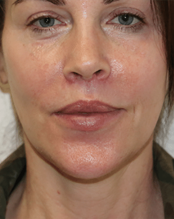 After Image: Lip Lift - front