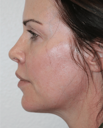 After Image: Lip Lift - front