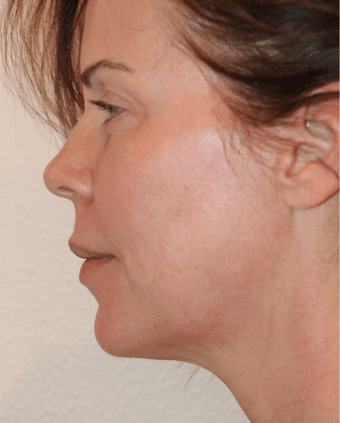 Before Image: Lip Lift - front