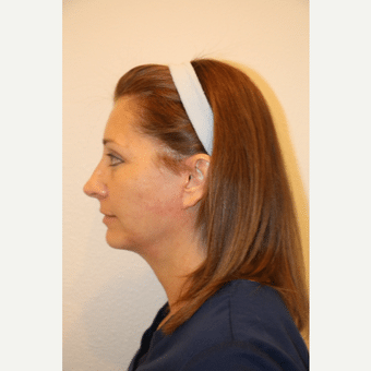 After Image: Neck Lift - left-side