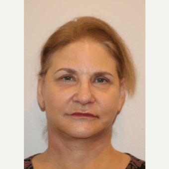 After Image: Neck Lift - front