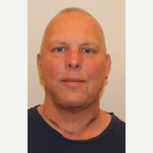 After Image: Neck Lift