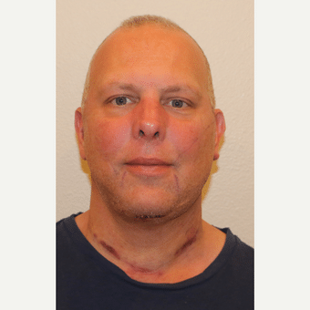 After Image: Neck Lift - front