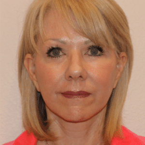 After Image: Neck Lift