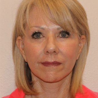 After Image: Neck Lift - front