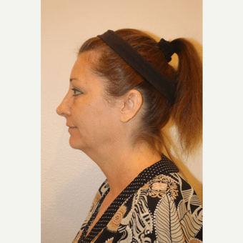 Before Image: Neck Lift - left-side