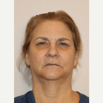 Before Image: Neck Lift - front