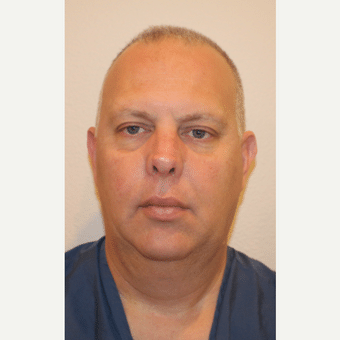 Before Image: Neck Lift - front