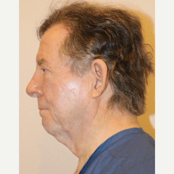 Before Image: Neck Lift - left-side