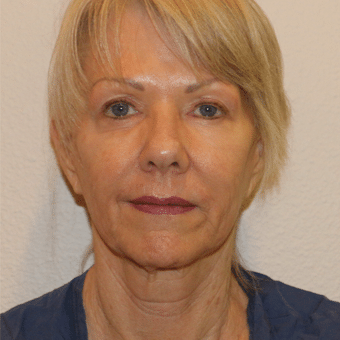 Before Image: Neck Lift - front