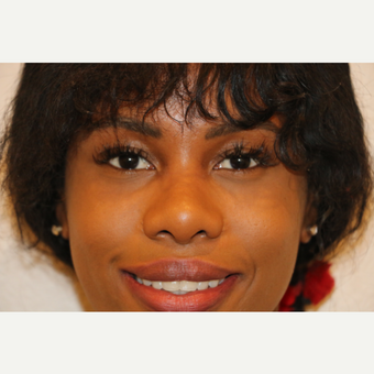 After Image: Rhinoplasty - front