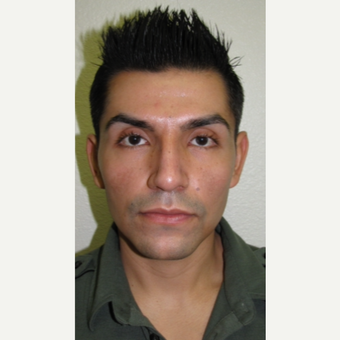 After Image: Rhinoplasty - front