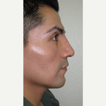 After Image: Rhinoplasty - front