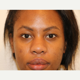 Before Image: Rhinoplasty - front