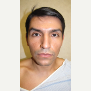 Before Image: Rhinoplasty