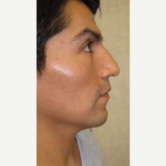 Before Image: Rhinoplasty - front
