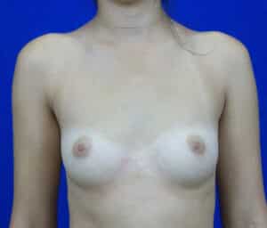 Before Image: Breast Augmentation