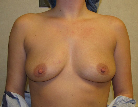 Before Image: Breast Augmentation - front