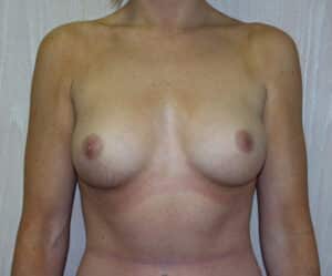 Before Image: Breast Augmentation