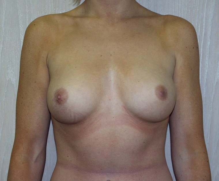 Before Image: Breast Augmentation - front