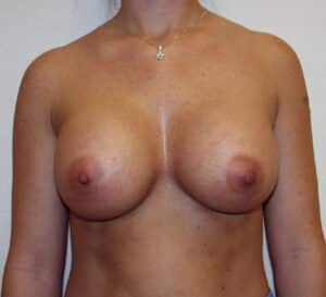 After Image: Breast Augmentation