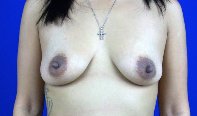 Before Image: Breast Augmentation - front